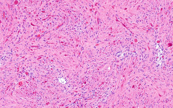 14B3 Astrocytoma, pilocytic (Case 14) H&E 9