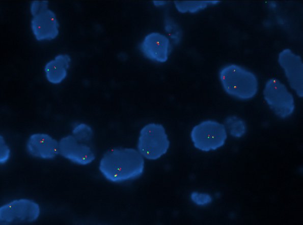 14D Astrocytoma, pilocytic (Case 14) BRAF fusion - Copy