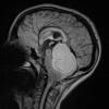 15A Astrocytoma, pilocytic (Case 15) FLAIR - Copy