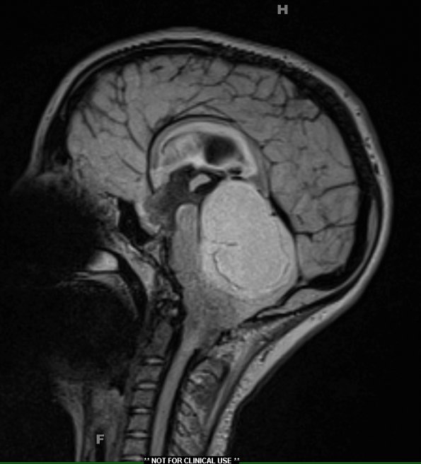 15A Astrocytoma, pilocytic (Case 15) FLAIR - Copy