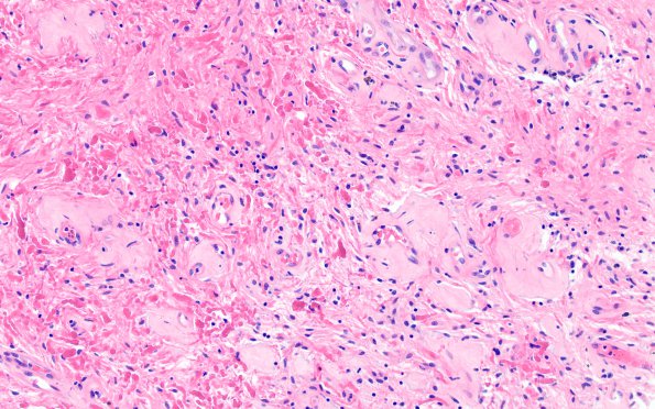 15B1 Astrocytoma, pilocytic (Case 15) H&E 6