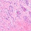 15B2 Astrocytoma, pilocytic (Case 15) H&E 5