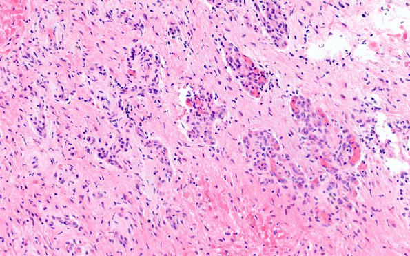 15B2 Astrocytoma, pilocytic (Case 15) H&E 5