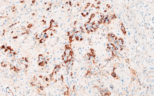 15B3 Astrocytoma, pilocytic (Case 15) CD31 1