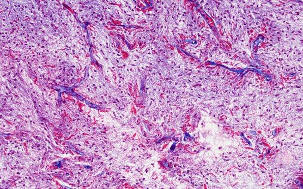 15C Astrocytoma, pilocytic (Case 15) Trichrome