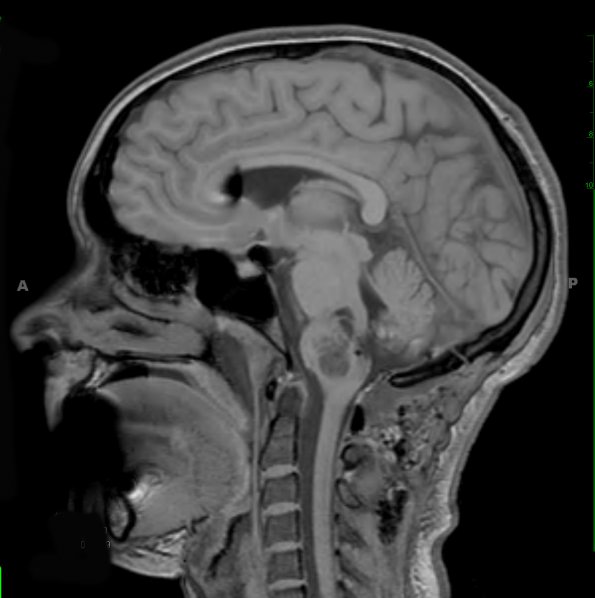 16A1 Astrocytoma, pilocytic (Case 16) T1 - Copy