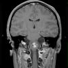 16A2 Astrocytoma, pilocytic (Case 16) T1 FL2D W 2 - Copy