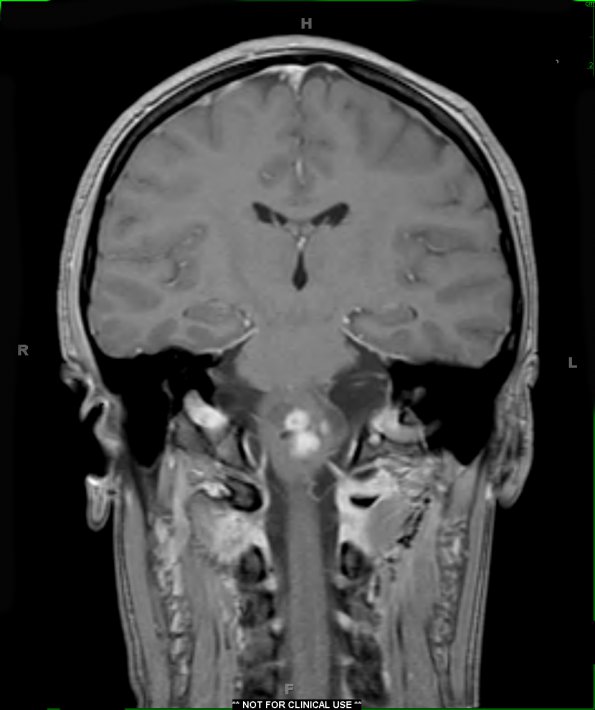 16A2 Astrocytoma, pilocytic (Case 16) T1 FL2D W 2 - Copy