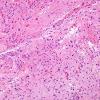 16B1 Astrocytoma, pilocytic (Case 16) H&E 1