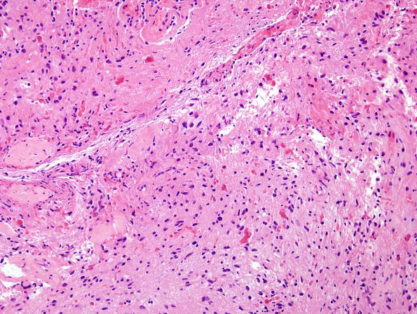 16B1 Astrocytoma, pilocytic (Case 16) H&E 1