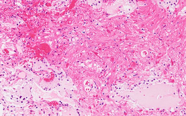 17A Astrocytoma, pilocytic (Case 17) H&E 2