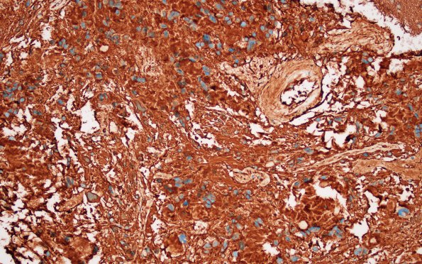 17B Astrocytoma, pilocytic (Case 17) GFAP 1