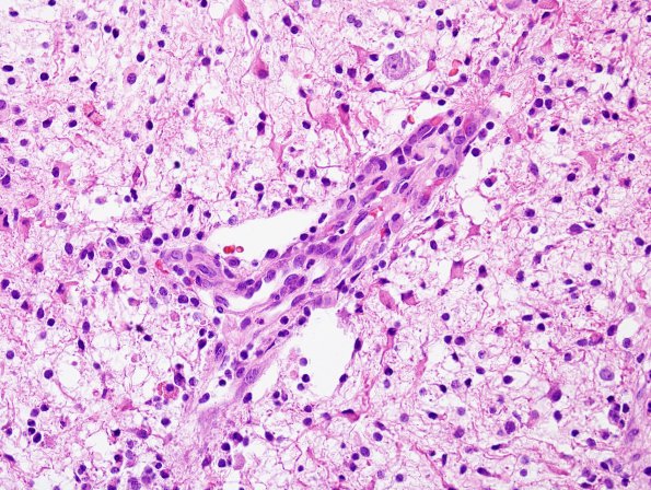 18A Astrocytoma, pilocytic (Case 18) H&E 4