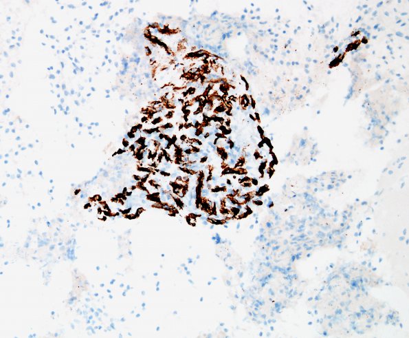 18B Astrocytoma, pilocytic (Case 18) CD34 2