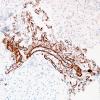 18C1 Astrocytoma, pilocytic (Case 18) SMA 2