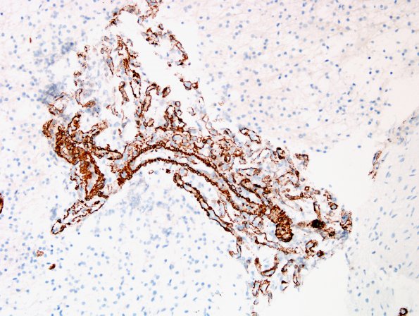 18C1 Astrocytoma, pilocytic (Case 18) SMA 2