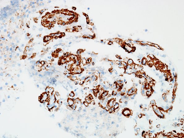 18C2 Astrocytoma, pilocytic (Case 18 SMA 3