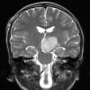 19A Astrocytoma, pilocytic (Case 19) T2 - Copy