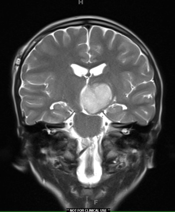 19A Astrocytoma, pilocytic (Case 19) T2 - Copy