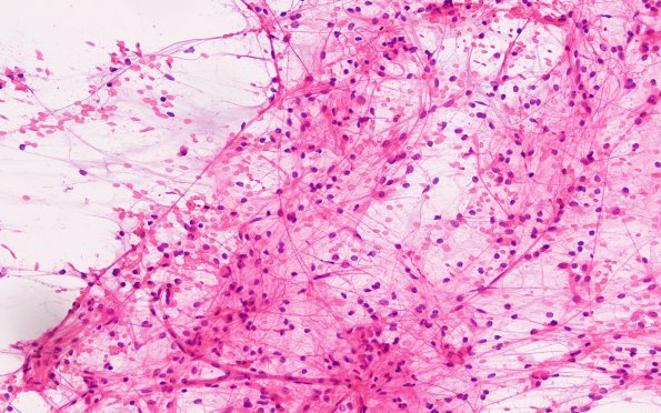 19B1 Astrocytoma, pilocytic fusion (Case 19) H&E smear