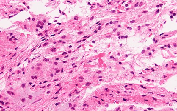 19B2 Astrocytoma, pilocytic fusion (Case 19) H&E 60X