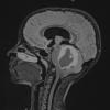 1A1 Astrocytoma, pilocytic (Case 1) FLAIR - Copy