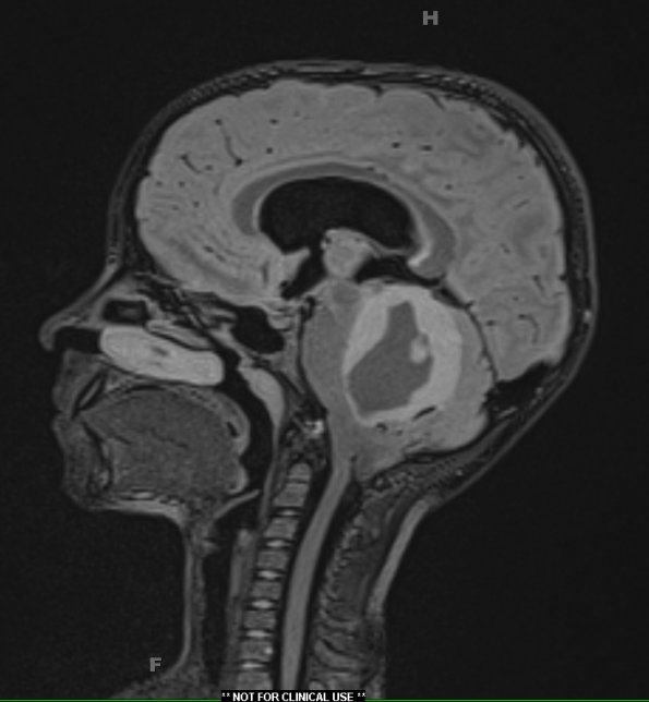 1A1 Astrocytoma, pilocytic (Case 1) FLAIR - Copy