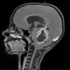 1A2 Astrocytoma, pilocytic (Case 1) T1 W contrast 5 - Copy