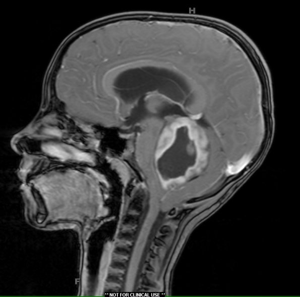 1A2 Astrocytoma, pilocytic (Case 1) T1 W contrast 5 - Copy