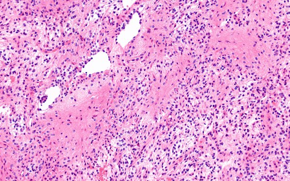 1B1 Astrocytoma, pilocytic (Case 1) H&E 6