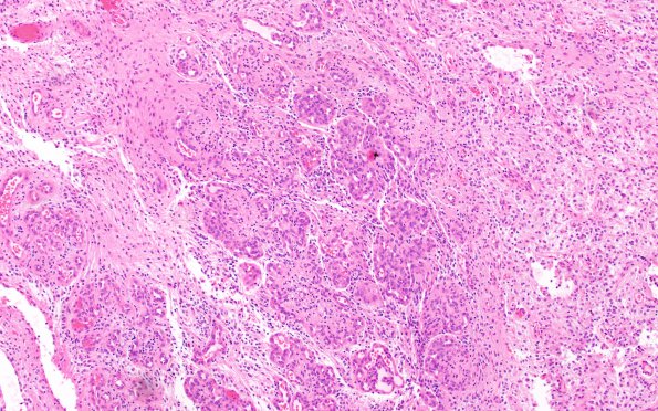 1B2 Astrocytoma, pilocytic (Case 1)