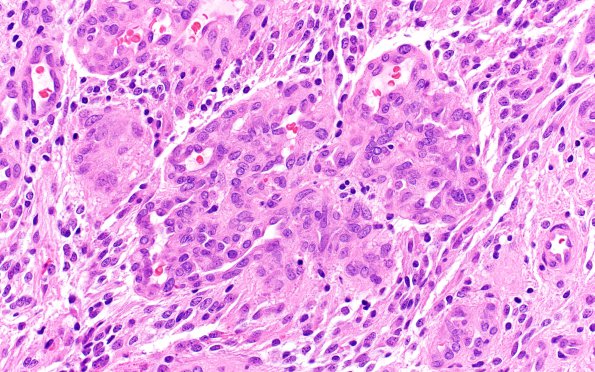 1B3 Astrocytoma, pilocytic (Case 1)  40X 2