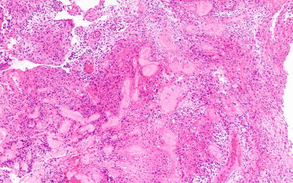 1B4 Astrocytoma, pilocytic (Case 1)  10X