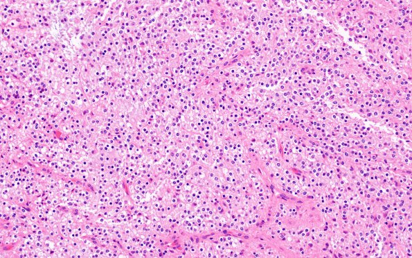 1B5 Astrocytoma, pilocytic (Case 1) H&E 1