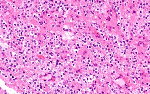 1B6 Astrocytoma, pilocytic (Case 1) H&E 4