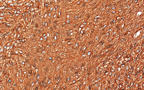 1C1 Astrocytoma, pilocytic (Case 1) GFAP 2