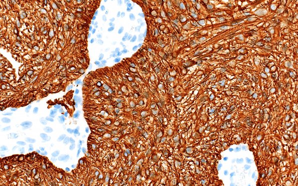 1C2 Astrocytoma, pilocytic (Case 1)  GFAP 40X 4