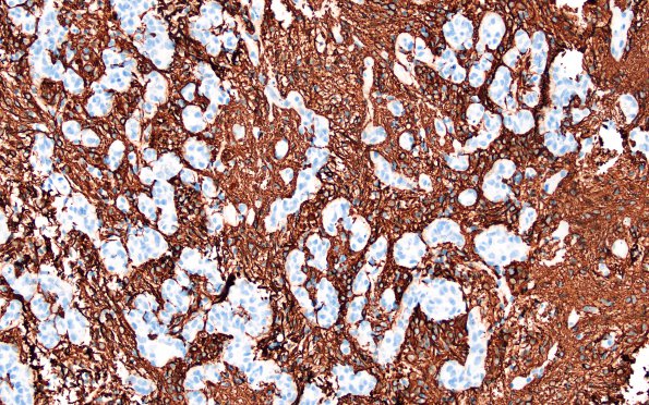 1C3 Astrocytoma, pilocytic (Case 1) GFAP 1