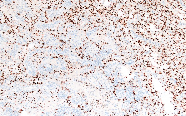 1D2 Astrocytoma, pilocytic (Case 1) Olig2 10X 2