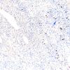 1F Astrocytoma, pilocytic (Case 1) Ki67 10X 3 copy