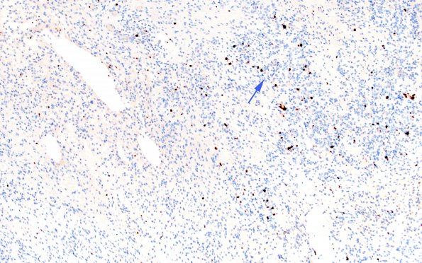 1F Astrocytoma, pilocytic (Case 1) Ki67 10X 3 copy