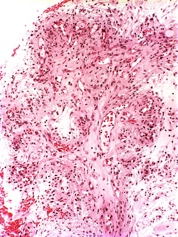 20 Astrocytoma, Pilocytic (Case 20) a