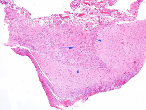 21A1 Astrocytoma, pilocytic (Case 21) H&E 6 copy copy