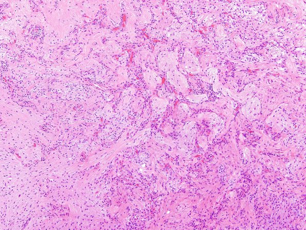 21A2 Astrocytoma, pilocytic (Case 21) H&E 3