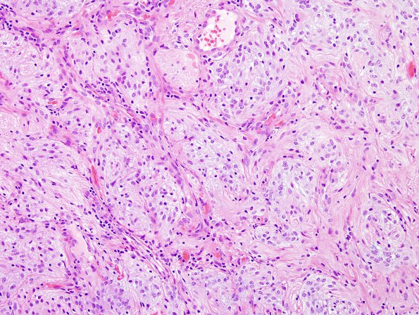 21A3 Astrocytoma, pilocytic (Case 21) H&E 2