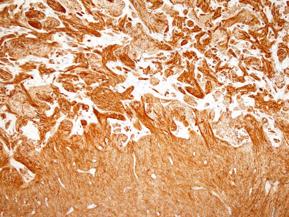 21B Astrocytoma, pilocytic (Case 21) GFAP 4