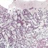 21C Astrocytoma, pilocytic (Case 21) Retic 1