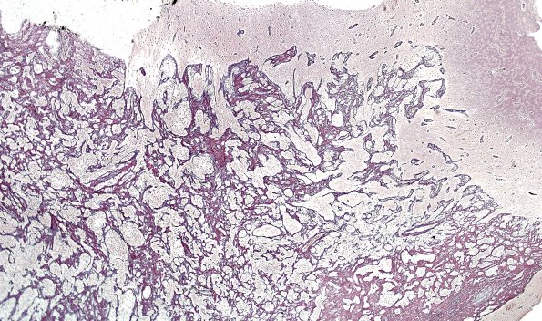 21C Astrocytoma, pilocytic (Case 21) Retic 1