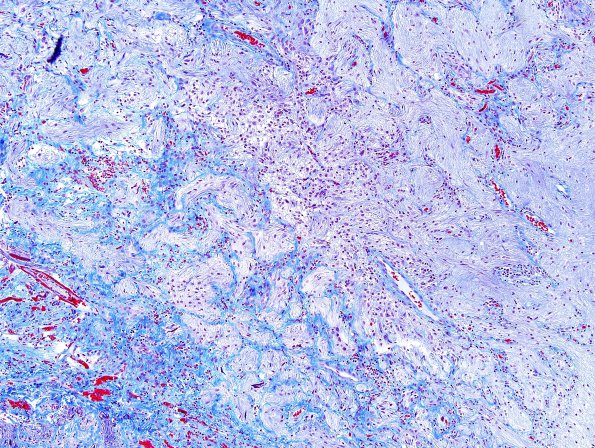 21D Astrocytoma, pilocytic (Case 21) Trichrome 1