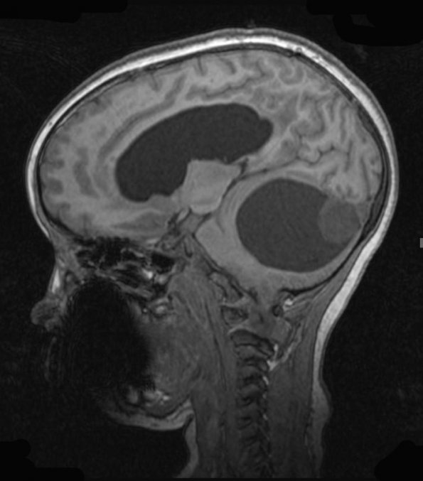 22A1 Astrocytoma, pilocytic (Case 22) T1 - Copy